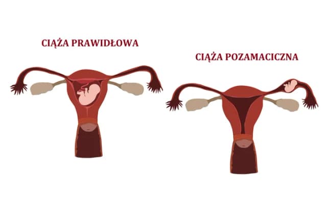 Ciąża pozamaciczna a test ciążowy - co musisz wiedzieć? Ciąża pozamaciczna a test ciążowy - co musisz wiedzieć?